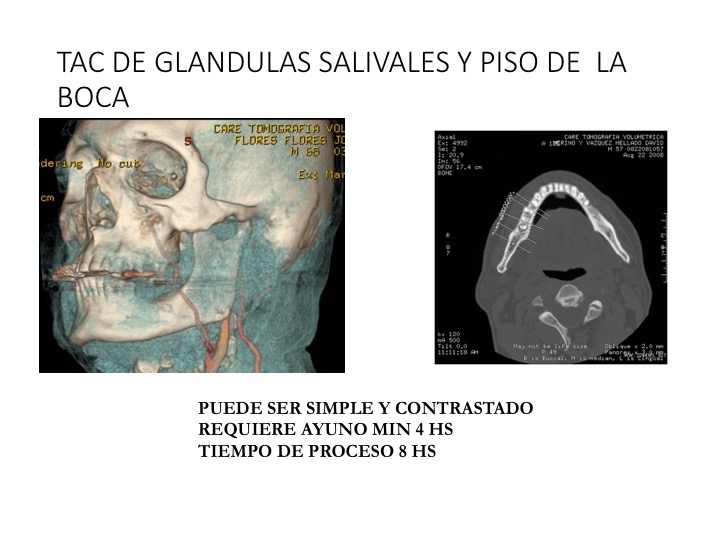 Tomografía de glandulas salivales