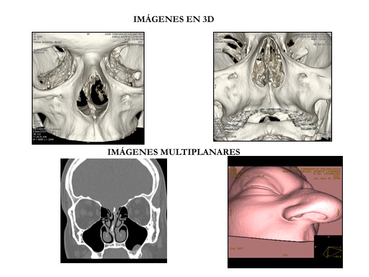 Tomografías en 3D