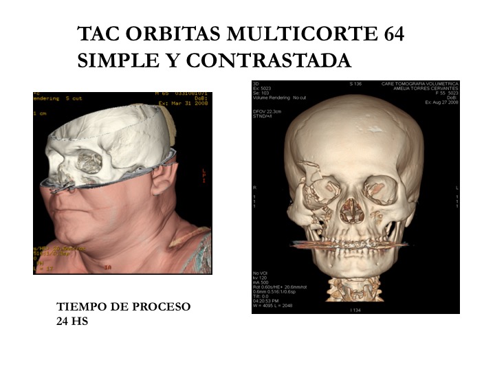 Tomografía Multicorte